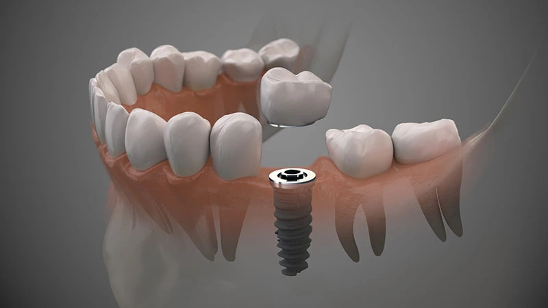 Implant dentar premium pentru un zâmbet perfect