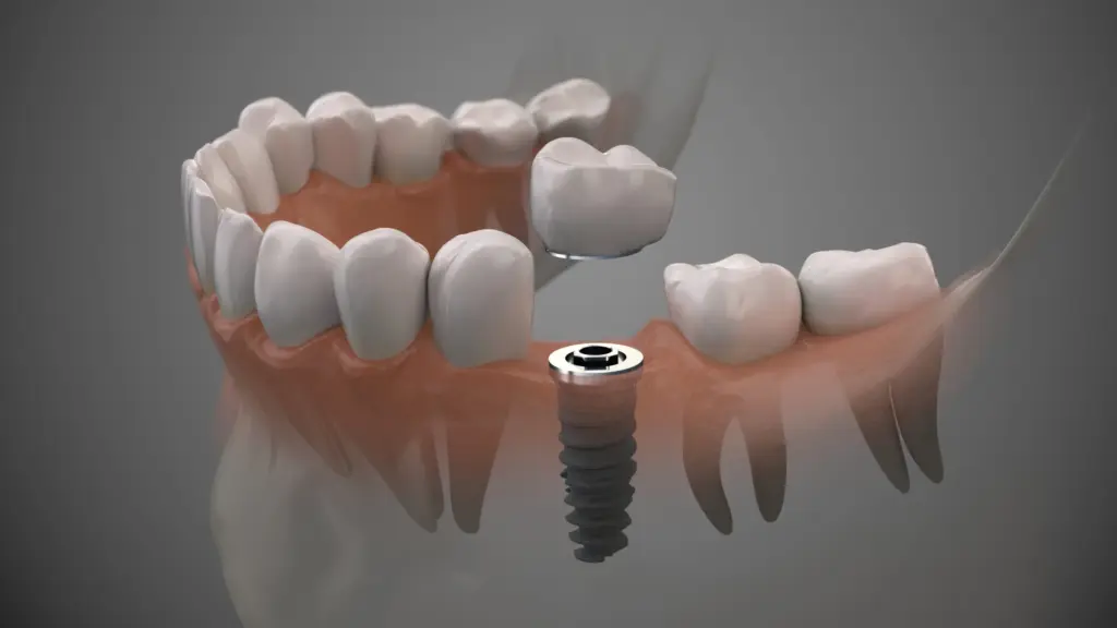 Mituri despre implantul dentar — Dental Planet