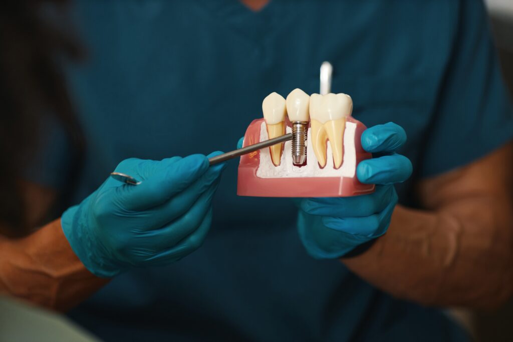 model demonstrativ cu un implant dentar inserat în os, alături de doi dinți naturali, ținut în mâini cu mănuși