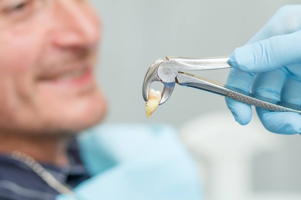 Extracția dentară