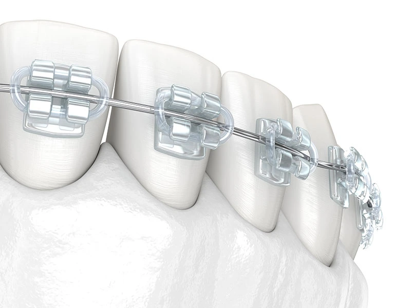 Ortodonție modernă pentru un zâmbet perfect