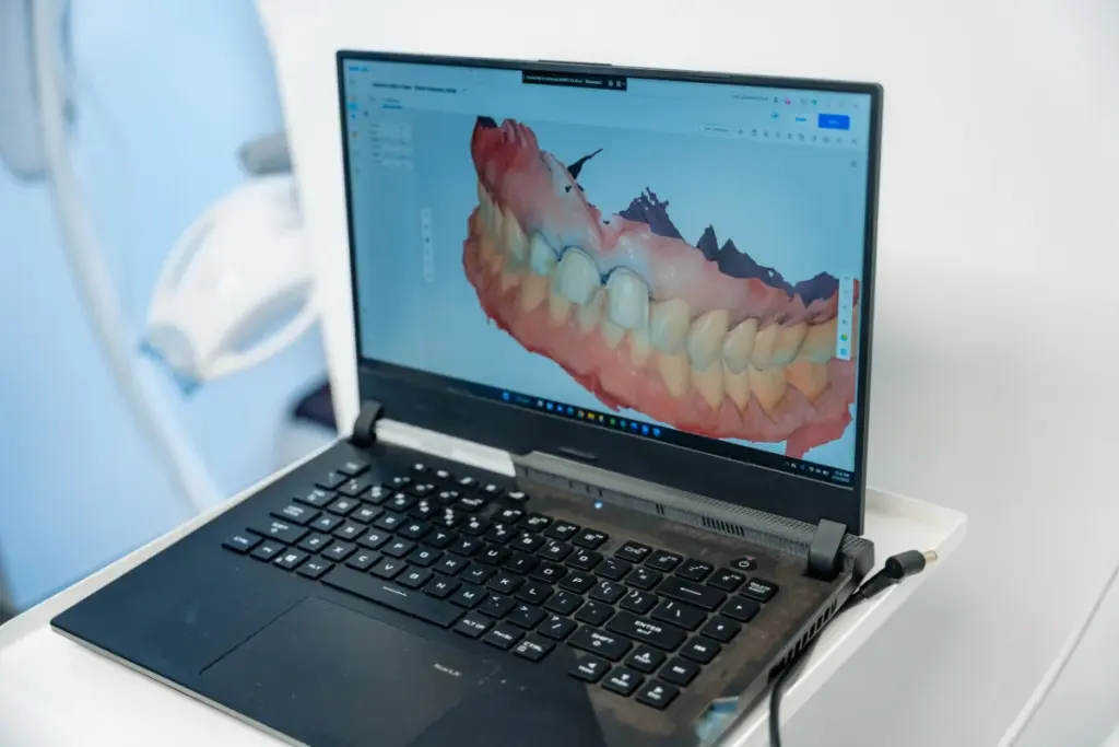 implant dentar Nobel Biocare - scanare digitala a arcadei pentru coroana