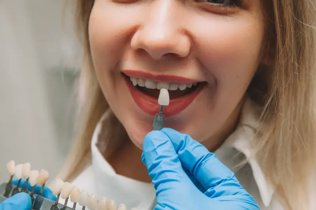 albire dentara profesionala - alegerea nuantei dintilor la Dental Planet