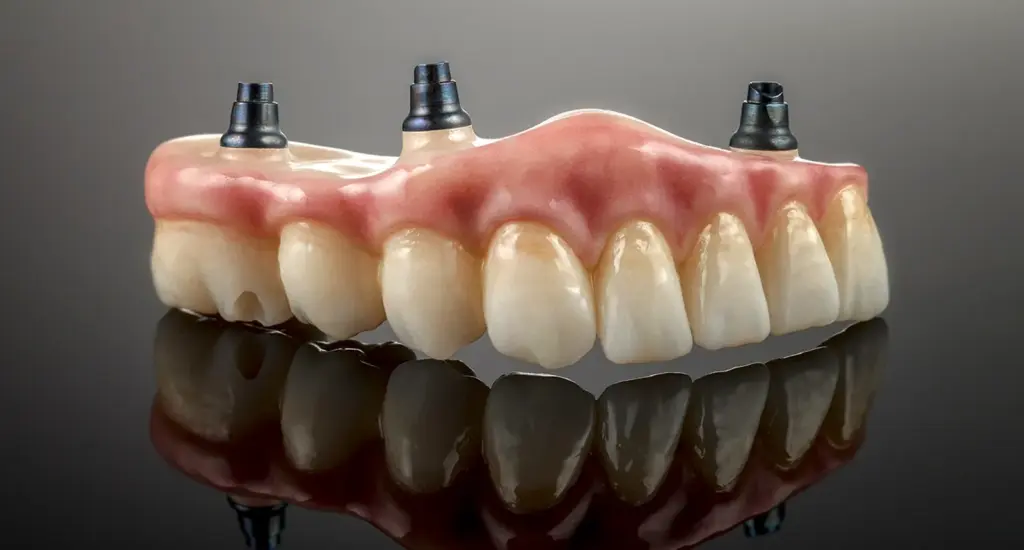 all on 4 - arcada completa fixa pe implanturi la Dental Planet