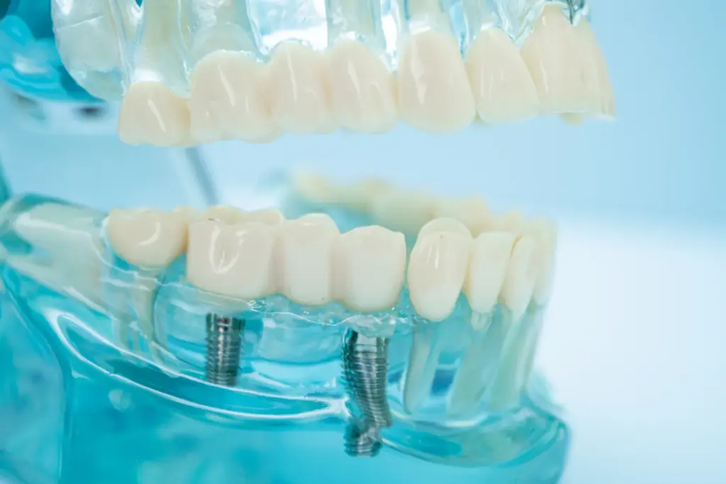 all on 6 - lucrare fixa pe 6 implanturi la Dental Planet