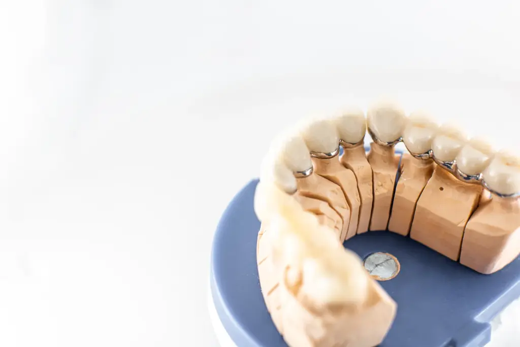 all on 4 - model de lucrare fixa pe implanturi la Dental Planet