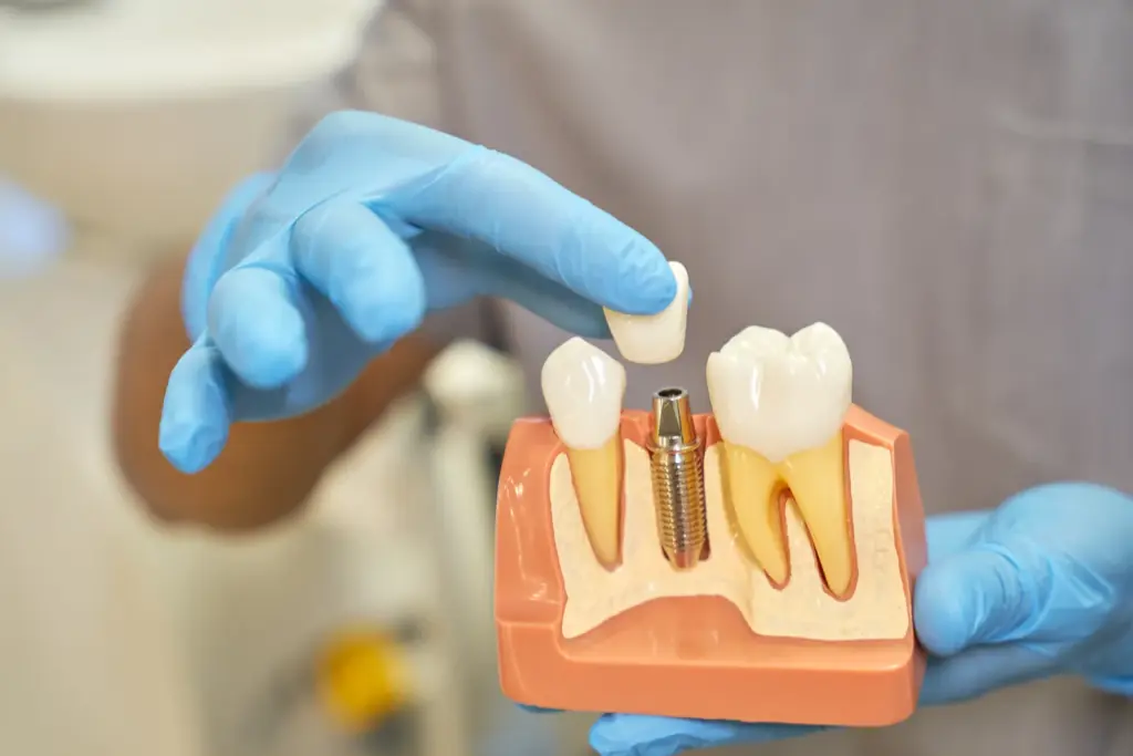 implant dentar Dentium - model cu implant si coroana separata