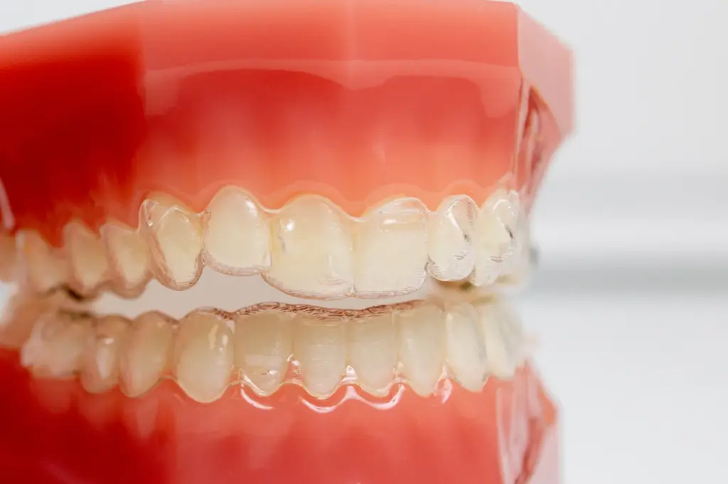 aparat dentar invizibil — gutieră transparentă aplicată pe un model dentar, pe ambele arcade