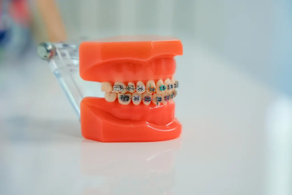 Model dentar cu aparat fix, folosit pentru comparația cu gutierele transparente