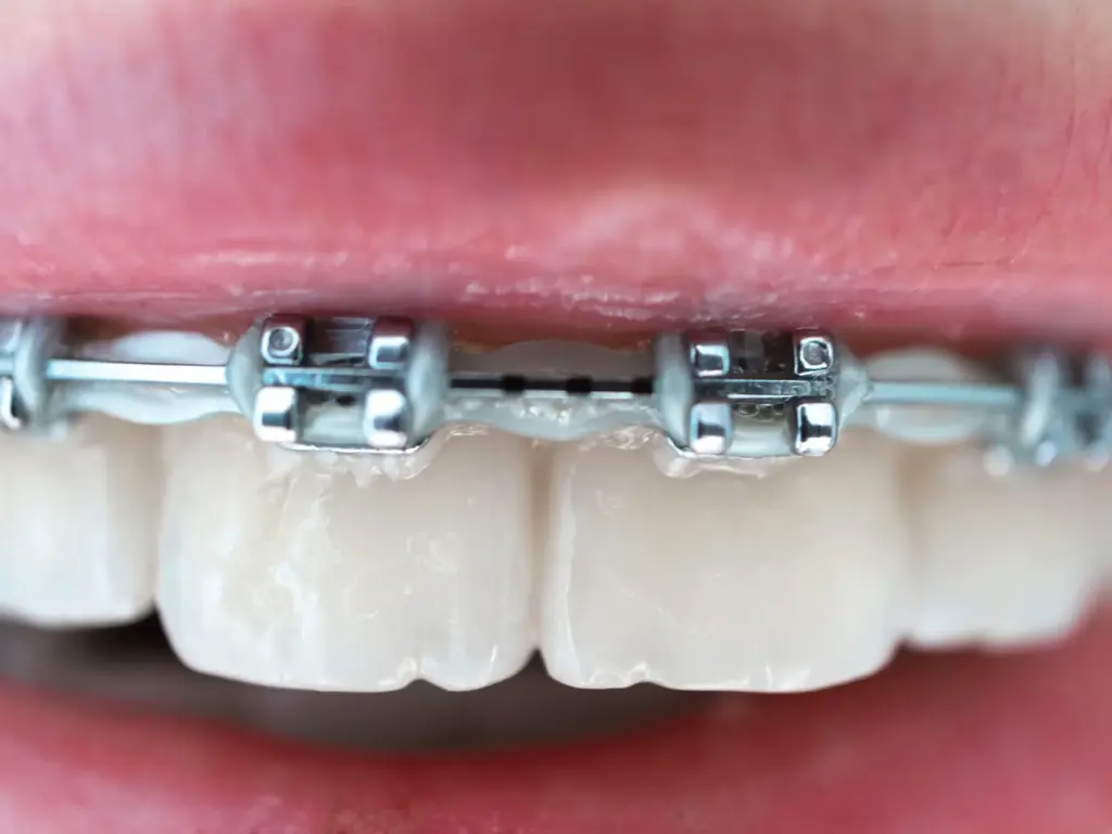 aparat dentar fix - bracket metalic si arc la Dental Planet