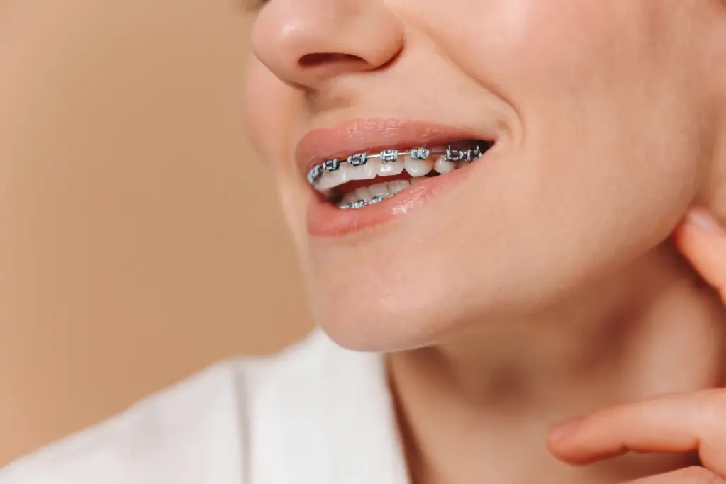 aparat dentar fix - pacienta cu aparat dentar fix la Dental Planet