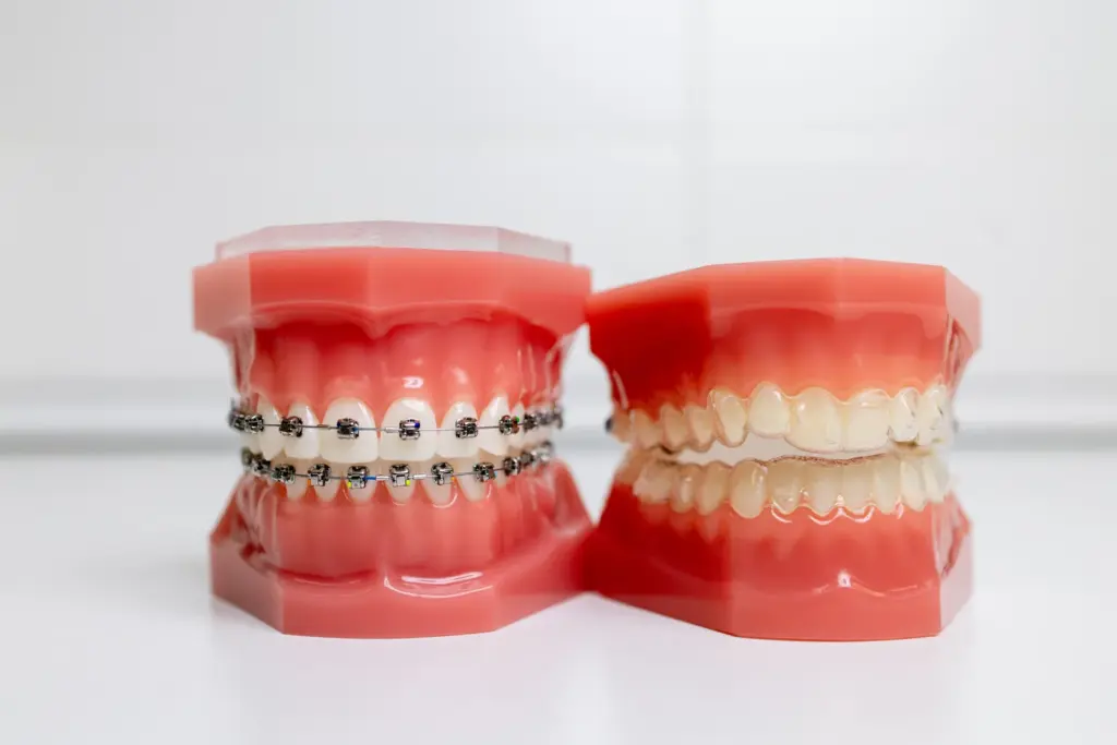 aparat dentar - bracketi si gutiere comparate la Dental Planet