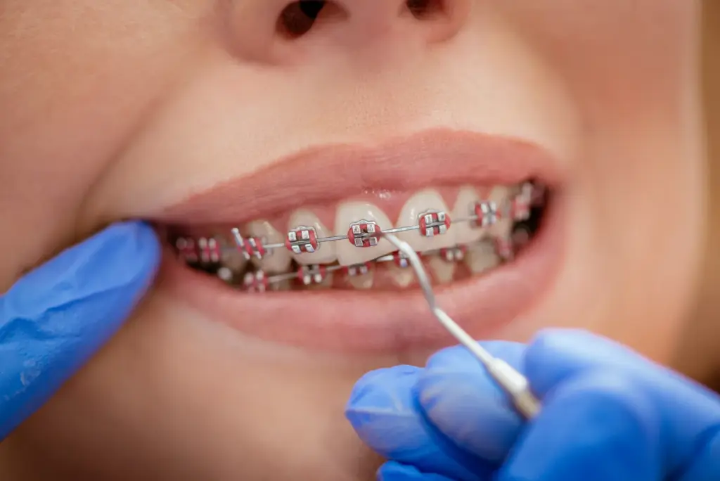 aparat dentar - tipuri de bracketi la Dental Planet