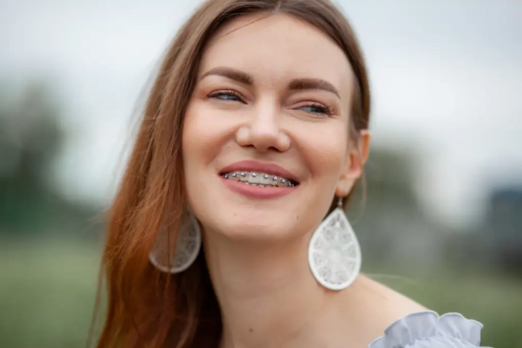 aparat dentar - rezultat dupa tratament ortodontic la Dental Planet