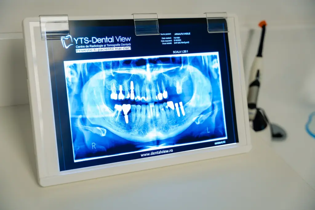 Radiografie panoramică pe negatoscop, pentru planul de implant dentar