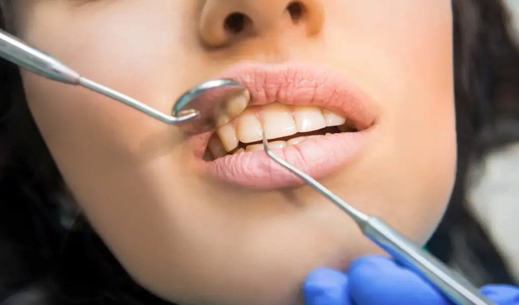 sinus lift - examinarea zonei laterale a maxilarului superior